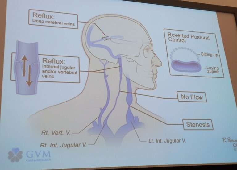 Il Team brain Flow e le ricerche sull’insufficienza Venosa Cerebrospinale