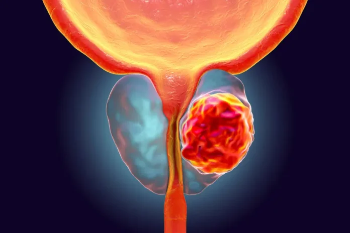 tumore alla prostata - carlo introini - qui salute magazine