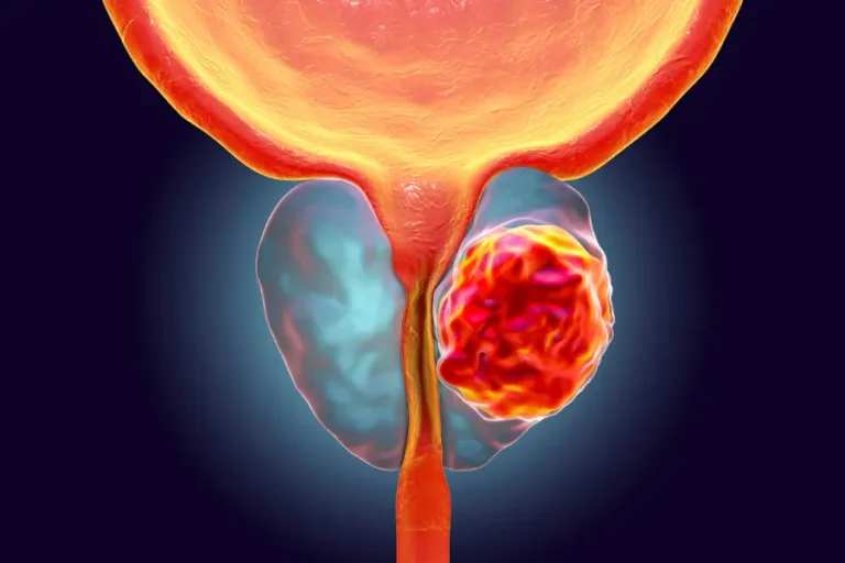 tumore alla prostata - carlo introini - qui salute magazine