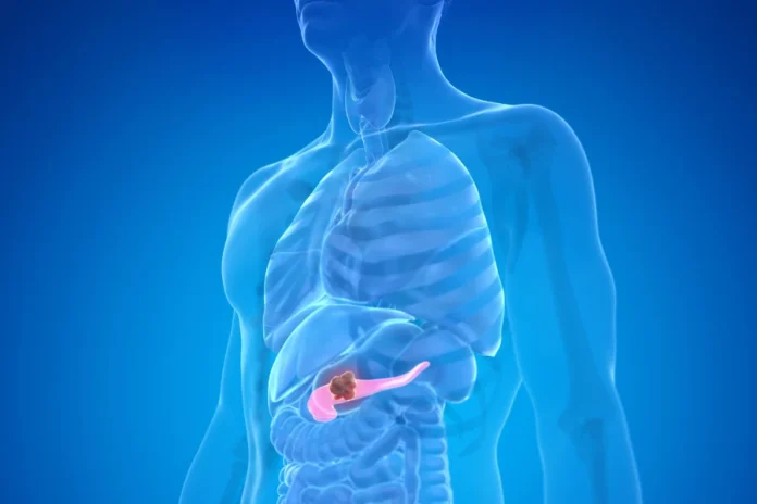 Tumore pancreas