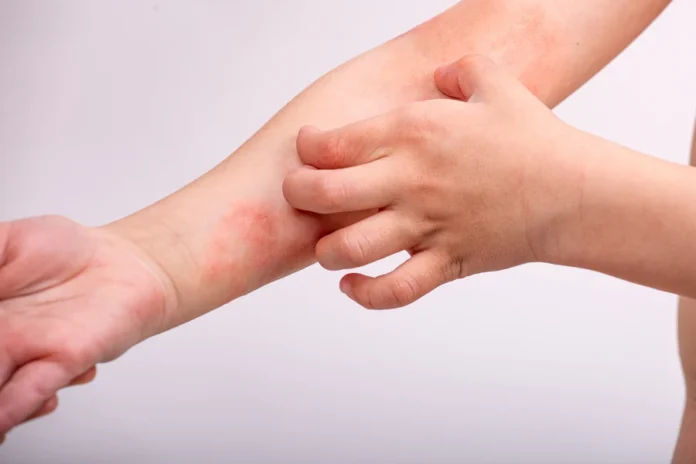 Dermatite atopica
