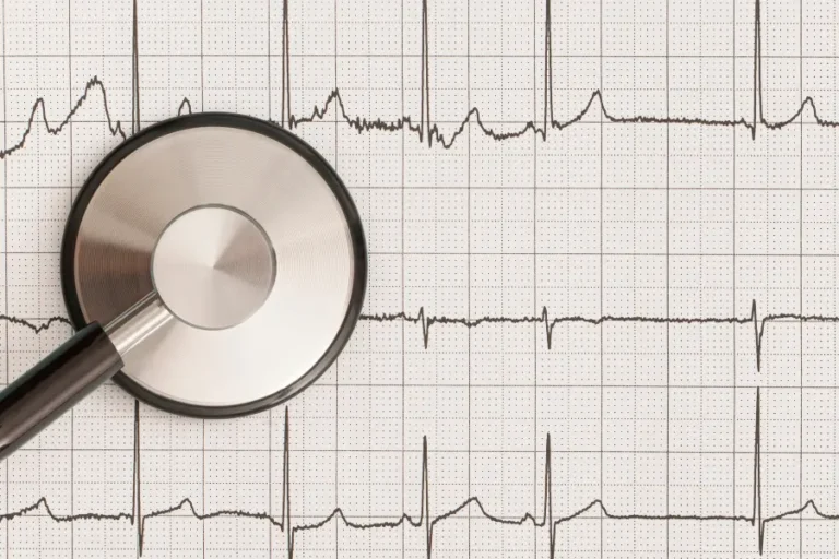 ecg