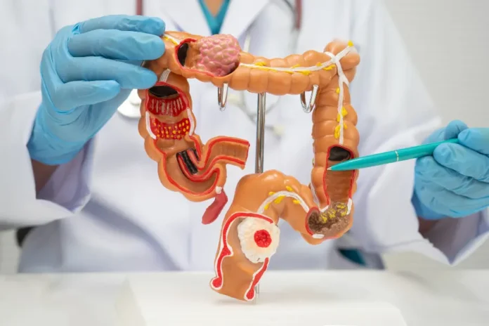 intestino artificiale qui salute magazine